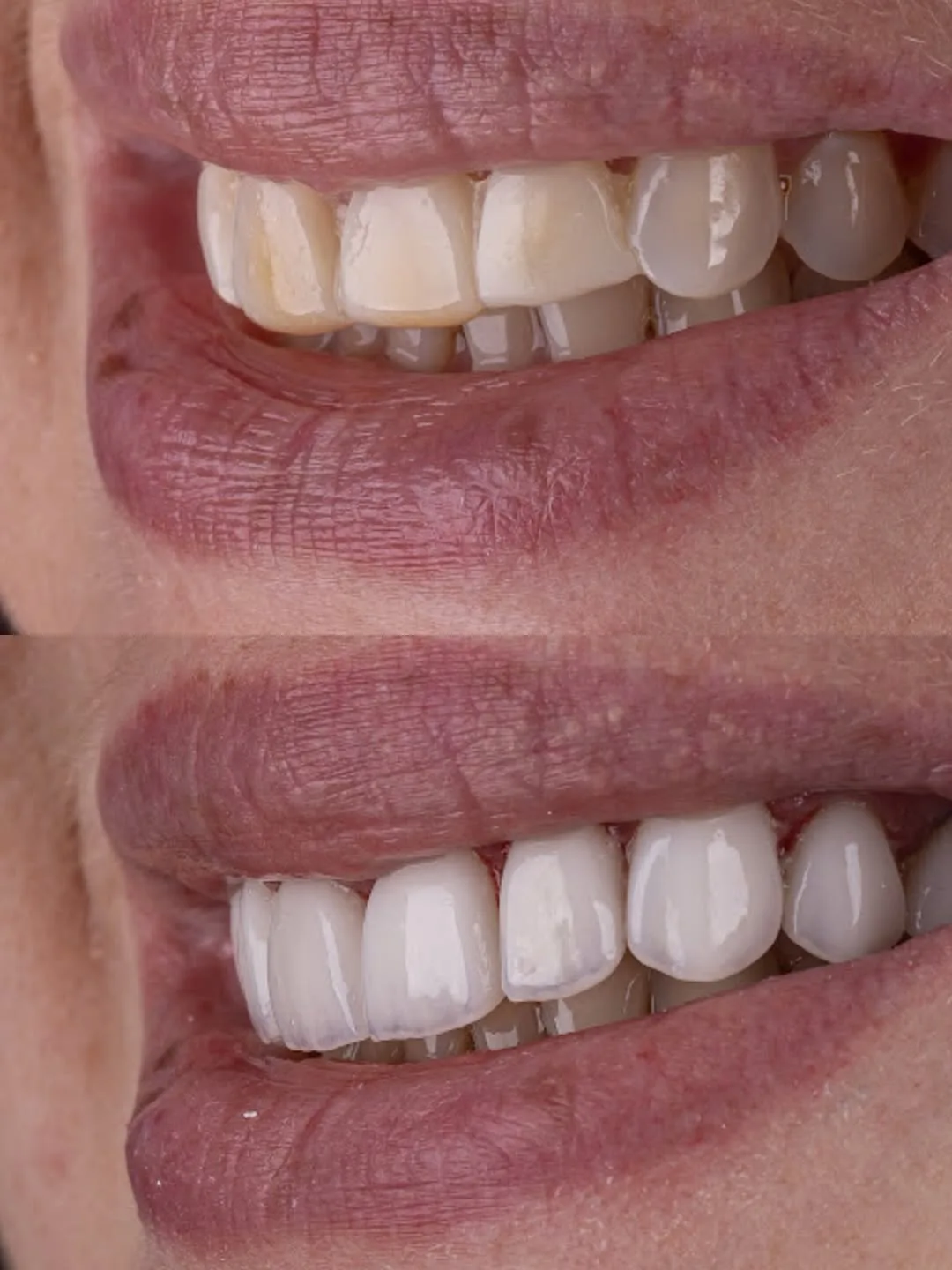 Lentes de contato dental — Antes e depois