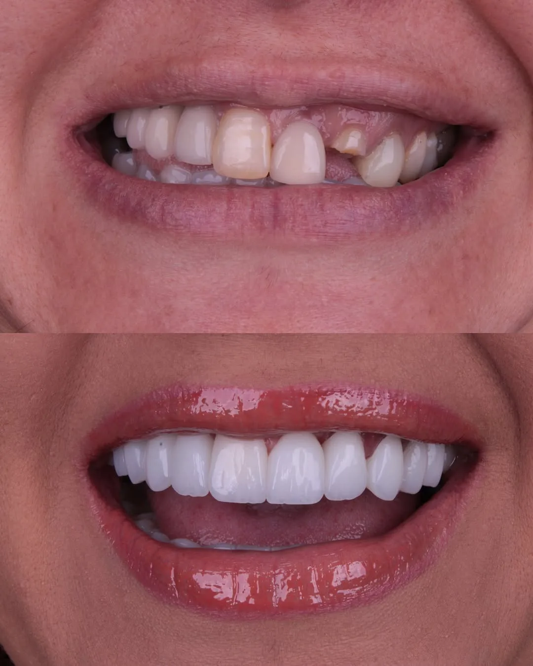 Reabilitação com lentes — Antes e depois